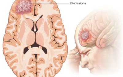Il glioblastoma